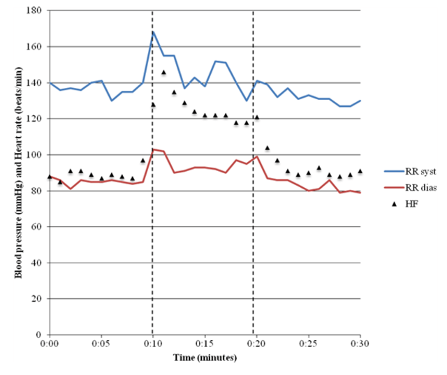 Tilt Table Test | A Key Diagnostic Tool for POTS 3 Tilt table test showing POTS.webp